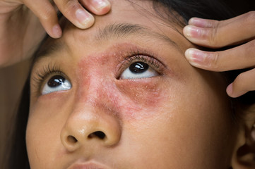 Southeast Asian ethnicity teenage girl with circular shape skin rash on her face around the eye and...