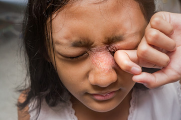 Fototapeta premium Southeast Asian ethnicity teenage girl annoyed with itchy skin disease, dermatitis problem on her face around the eye and nose, scratching over it