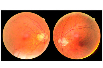 View inside human eye disorders - showing retina, optic nerve and macula.Retinal picture ,Medical...
