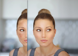 Dark spots, freckles,hyperpigmentation(melasma or chloasma)	