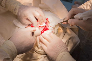 top view, stages of neurosurgical surgery for installing a titanium plate in the patients skull....