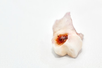 Dental caries on primary tooth. Deciduous tooth with caries on light background. Concept of visiting dentist regularly. Closeup, selective focus
