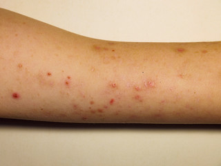 Skin allergic irritations in the form of a rash.