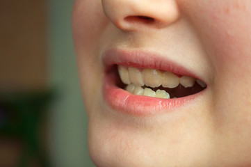 crooked teeth in a child