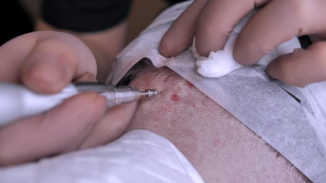 Patient's head close-up. Baldness treatment. Hair transplant. Surgical technique that moves hair follicles from a part of the head (FUE method).