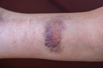 Fototapeta premium Purple bruise on the skin on a woman hand