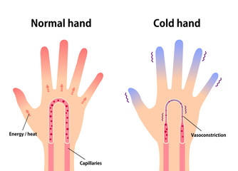 Comparison illustration of normal hand and cold hand ( sensitivity to cold, cold fingertips)