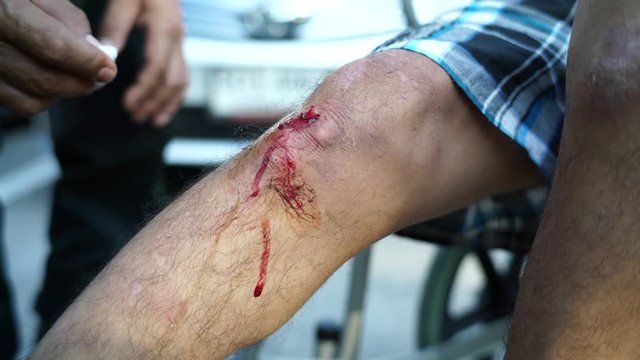  Disable men Knee scraping with blood sitting on wheelchair accident