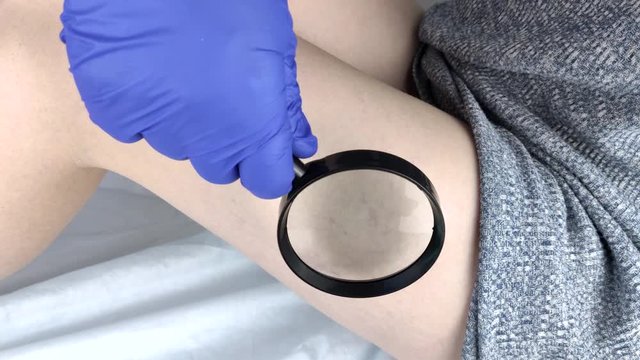 A vascular surgeon examines a leg with varicose veins. Vascular network and blood vessels are shown close-up through a magnifying glass. Preparation for laser treatment and sclerotherapy