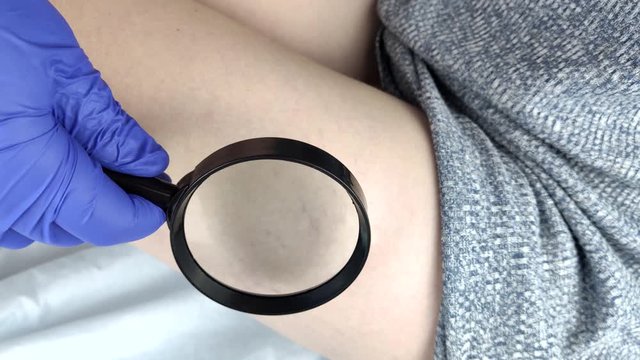 A vascular surgeon examines a leg with varicose veins. Vascular network and blood vessels are shown close-up through a magnifying glass. Preparation for laser treatment and sclerotherapy