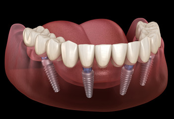 Fototapeta na wymiar Mandibular prosthesis All on 4 system supported by implants. Medically accurate 3D illustration of human teeth and dentures concept