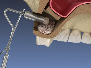 Sinus Lift Surgery - Adding new bone. 3D illustration © Alex Mit