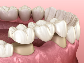 Fototapeta na wymiar Dental bridge of 3 teeth over molar and premolar. Medically accurate 3D illustration of human teeth treatment