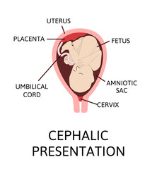 Different baby positions in the uterus during pregnancy.