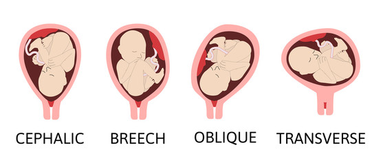 Different baby positions during pregnancy. Cephalic, Breech, transverse, Oblique lies. Colored medical vector illustration.