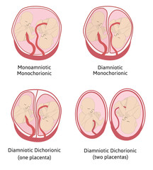 Anatomy of abdomen with twins. Twin types infographic elements in flat design.