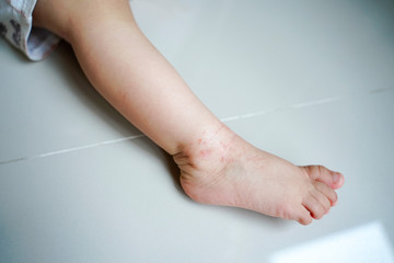Closeup focus on ankle area of small baby leg , covered by eczema with red dry and scratched skin,allergy from food or contact allergic reaction or Irritant contact dermatitis in baby skin.