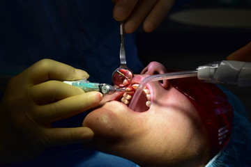 Drilling a hole for placement of a dental implant replacing Upper Right Lateral Incisor
