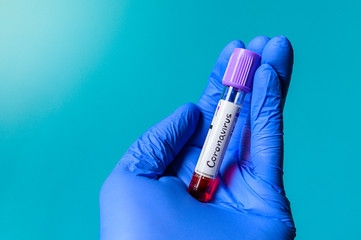 A positive blood test result for the new rapidly spreading Coronavirus, Covid-19