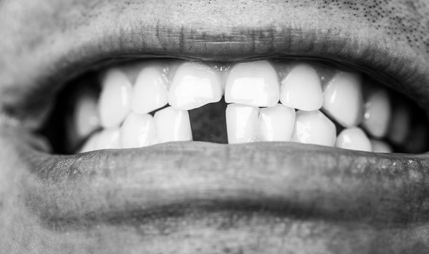 Bad Dental Health, No Teeth, No Fluoride, Tooth Erosion. Man Without One Front Tooth. No Teeth. Smile Men With A Lost Front Tooth, Toothache. Black And White