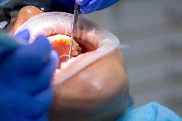 Asian female patient on dentist appointment during dental procedure. Human mouth open close up....