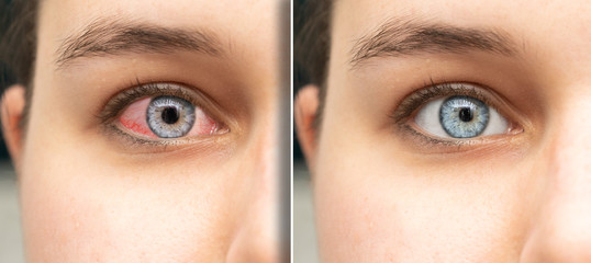 Detail of women red irritated eye before and after eyedrop treatment. Healthcare and eyecare...