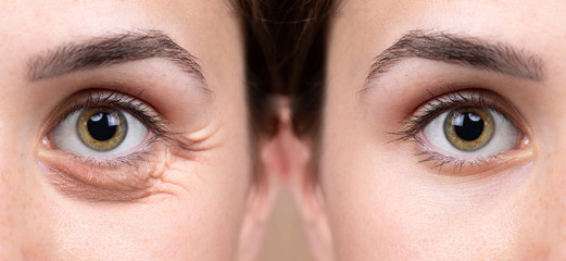 Before and after eye bags and wrinkles removing comparison. Closeup view of aged caucasian women...