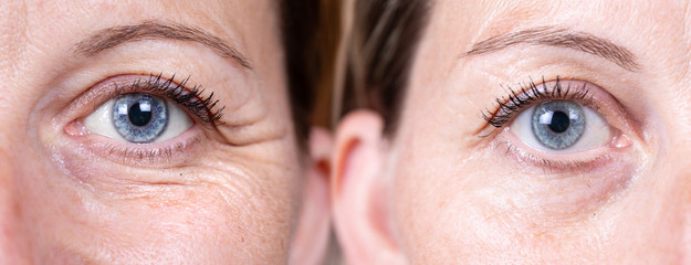 Collage comparison before and after beauty care. Closeup view of aged women eyes. ..