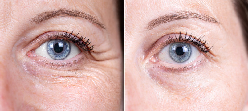 Collage comparison of before and after beauty care. Closeup view of female eyes. ..
