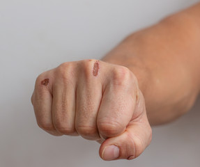 Fototapeta premium skin damage on the arm