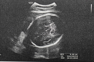 Ultrasound of baby in pregnant woman, Doctor reading test results of pregnant woman by ultrasound.