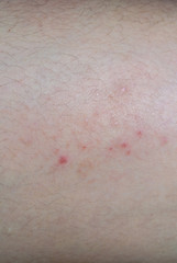 Fototapeta premium The skin of patients with dengue fever