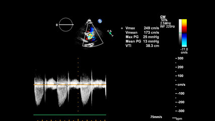 Image of the heart during transesophageal ultrasound with Doppler mode.