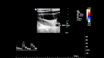 Pulse wave Doppler ultrasound examination of vessels.