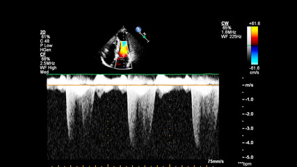 Image of the heart during transesophageal ultrasound with Doppler mode.