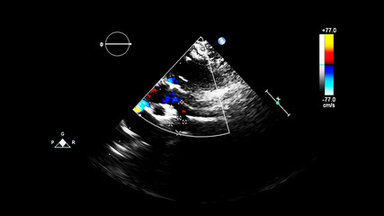 Image of the heart during transesophageal ultrasound with Doppler mode.