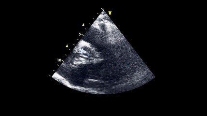 Image of the heart in gray-scale mode during transesophageal ultrasound.