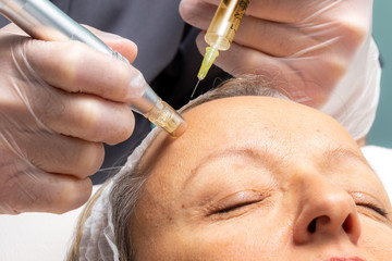 Detail of micro needle cosmetic facial treatment on middle aged woman.