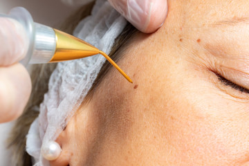 Macro close up of laser plasma pen removing facial wart on middle aged woman.