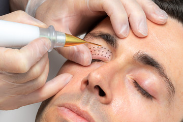 Middle aged man having laser plasma pen therapy on eyelids.