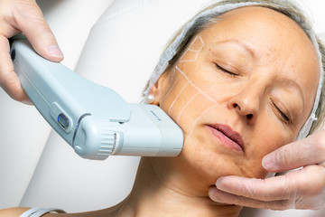 Top view of middle aged woman having skin tightening ultrasound treatment on chin.