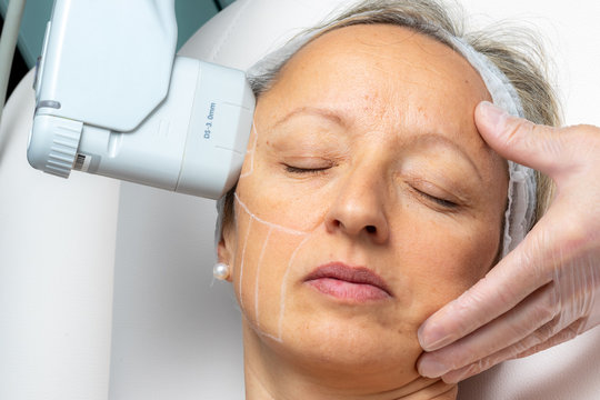 Top view of middle aged woman having facial hifu energy treatment.