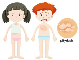 Diagram showing pityriasis in children