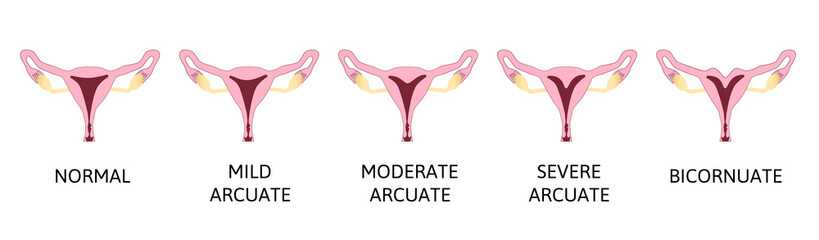 The shape of the uterus, the female reproductive organ.
