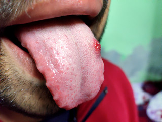 A closeup of a diseased tongue in which a red spot glosses. Burning and discomfort of the tongue