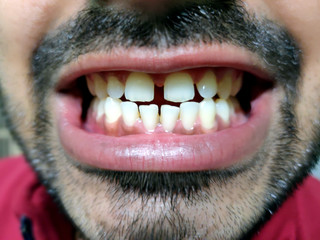 A man with a beard shows his teeth, he has a tooth gap.
