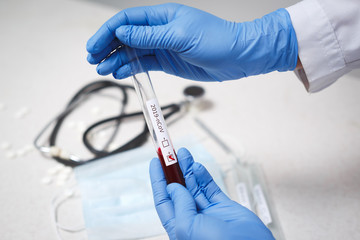Blood test tube in doctor hand, Mers-CoV Coronavirus test Positive label in hospital blood test tube for analysis. 2019-nCoV virus infection originating in Wuhan, China