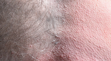 Male depilation. Half of male chest without hair after waxing. Close-up