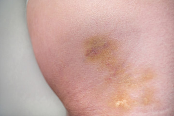 Skin bruises on Caucasian female buttocks side view close up shot no nudity