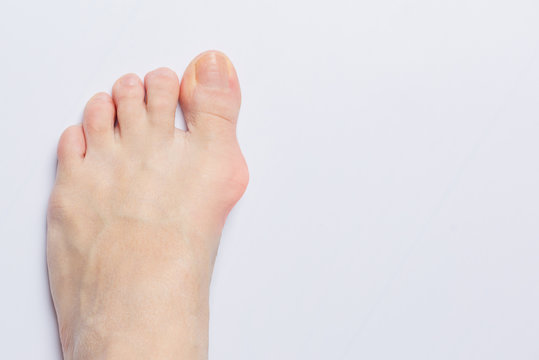 Bunion at side of a foot  isolated on gray white background